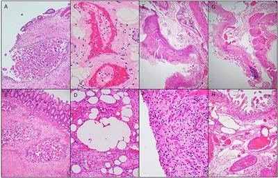 Gastrointestinal Manifestations of COVID-19 Infection: Clinicopathologic Findings in Intestinal Resections Performed at Single Institution